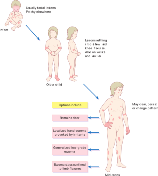 top 5 things about eczema top 5 things about eczema