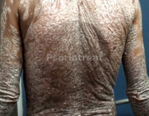 types of psoriasis