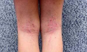eczema in marathi