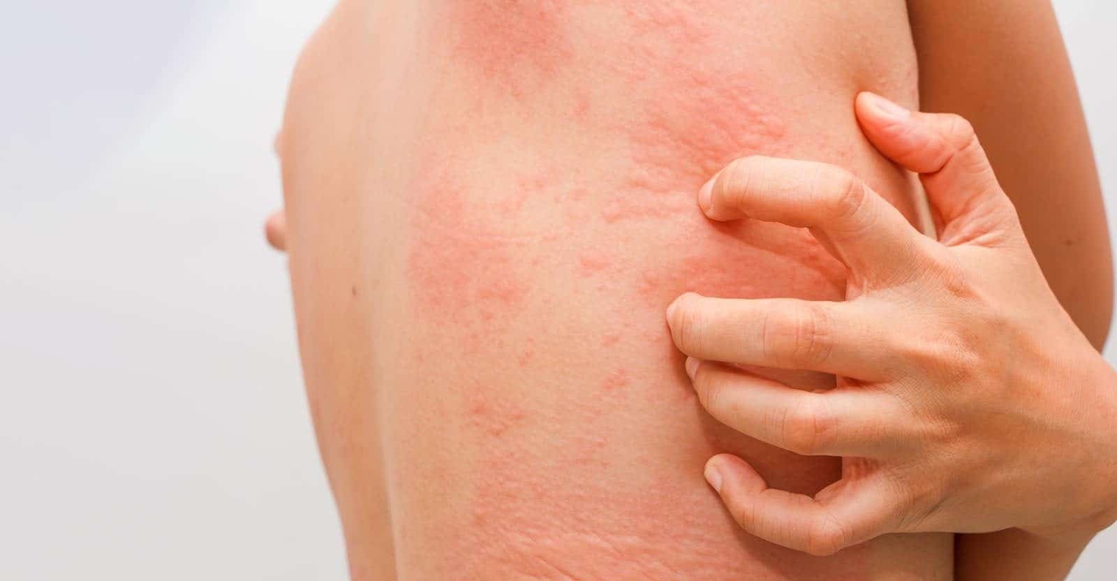 types of psoriasis