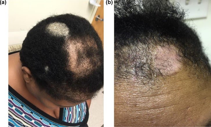 Scalp Psoriasis Hair Loss