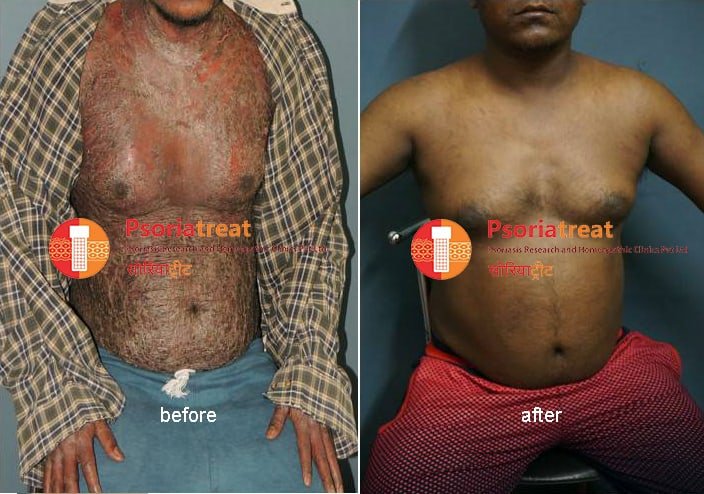 erythrodermic psoriasis treatment