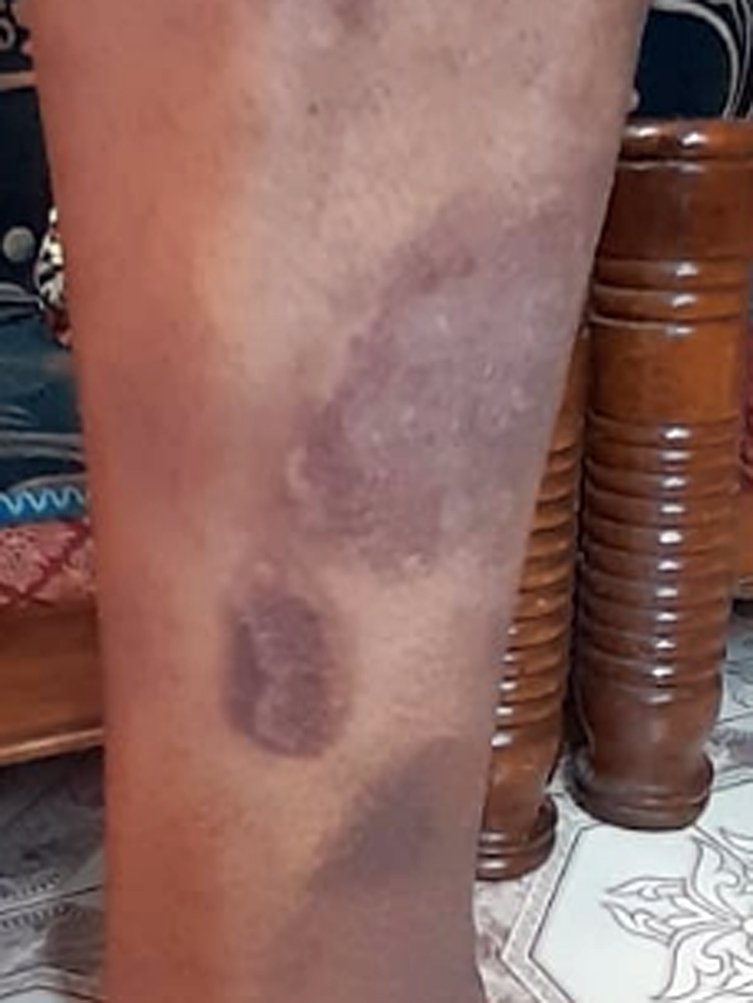 image of cured patient after treatment of psoriasis and lichen planus image of cured patient after treatment of psoriasis and lichen planus