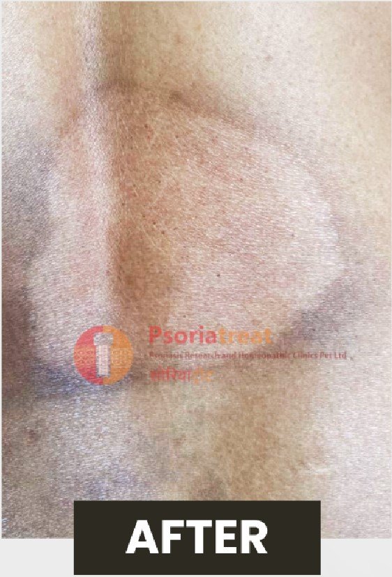chronic plaque psoriasis treatment