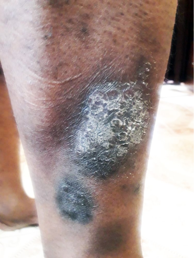 patient suffering from psoriasis and lichen planus patient suffering from psoriasis and lichen planus