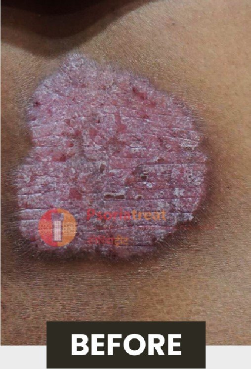chronic plaque psoriasis treatment chronic plaque psoriasis treatment