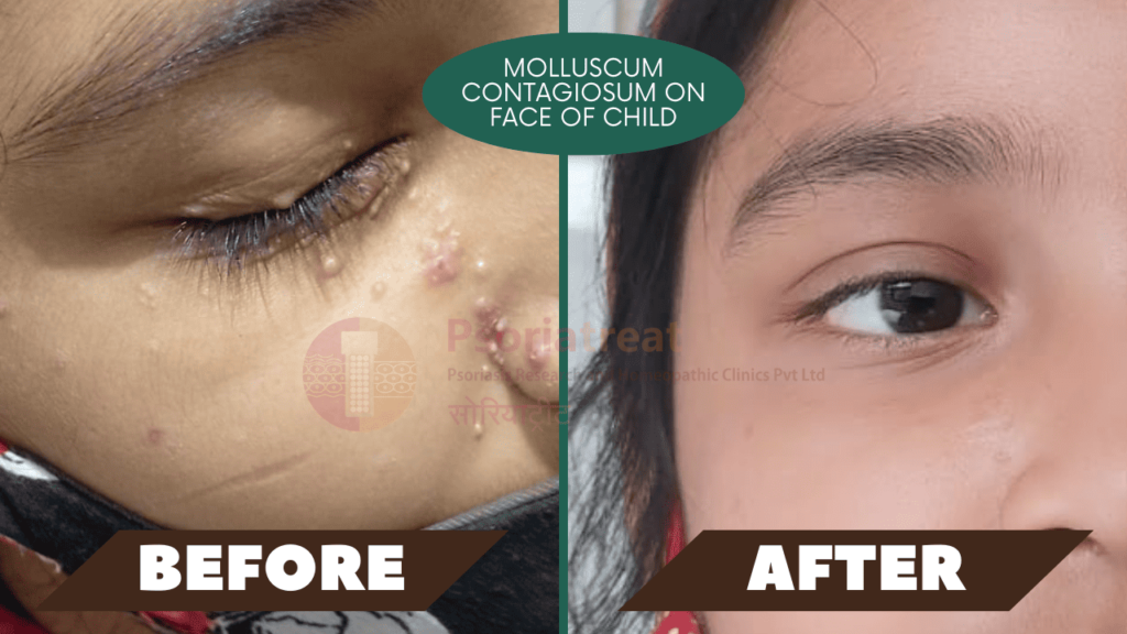 molluscum contagiosum on face of child molluscum contagiosum on face of child