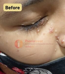 molluscum contagiosum on face of child molluscum contagiosum on face of child