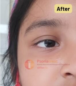 molluscum contagiosum on face of child molluscum contagiosum on face of child