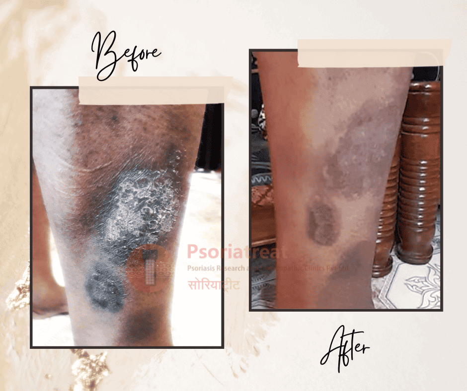 psoriasis and Lichen Planus patient case study