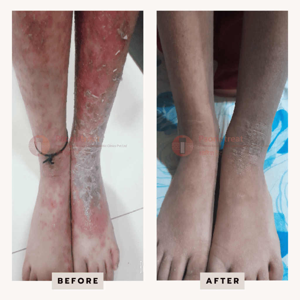 how to treat atopic dermatitis on feet