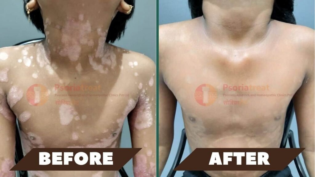 child plaque psoriasis on chest