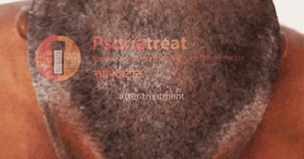 after treatment photo of a scalp psoriasis patient scalp psoriasis treatment doctor