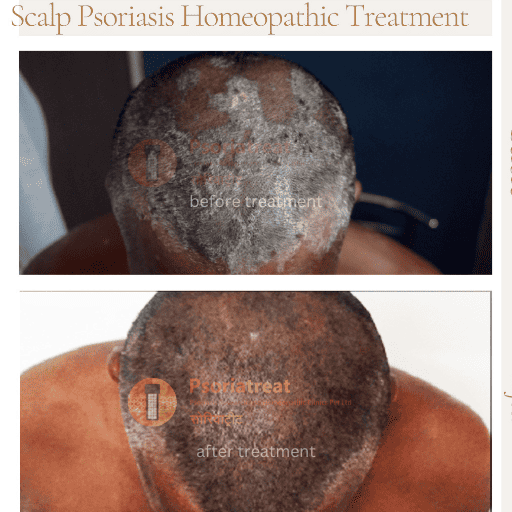 scalp psoriasis treatment in india scalp psoriasis treatment in india