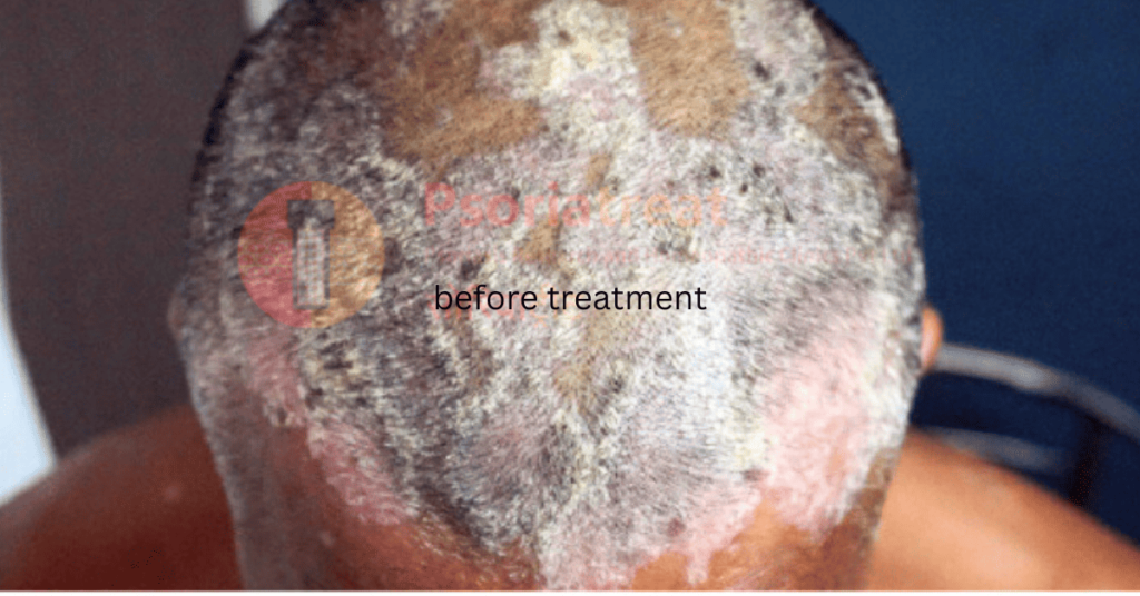 Before treatment photo of a scalp psoriasis patient scalp psoriasis treatment in pune