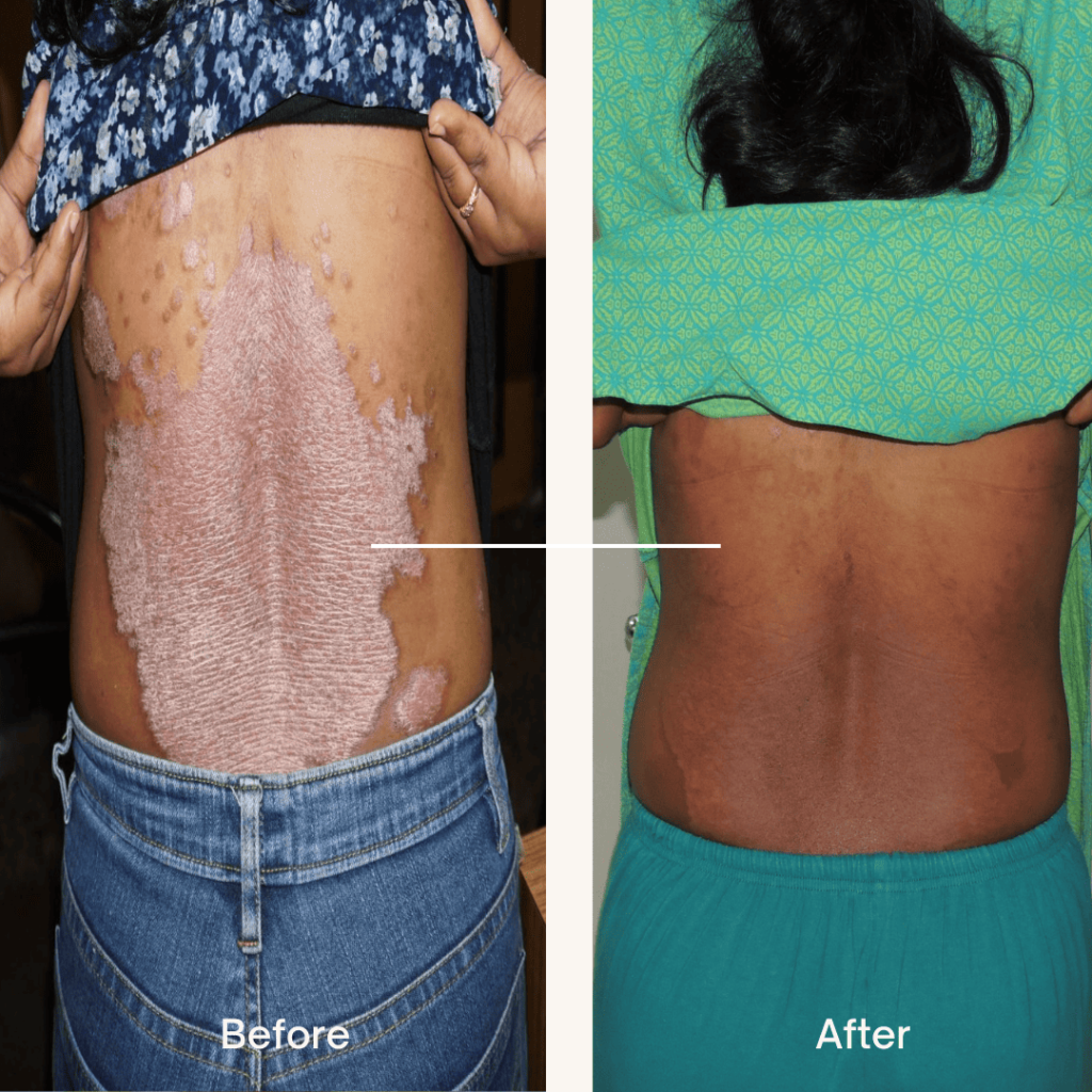 before after photo of a psoriasis patient before after photo of a psoriasis patient treated successfully using homeopathy treatment