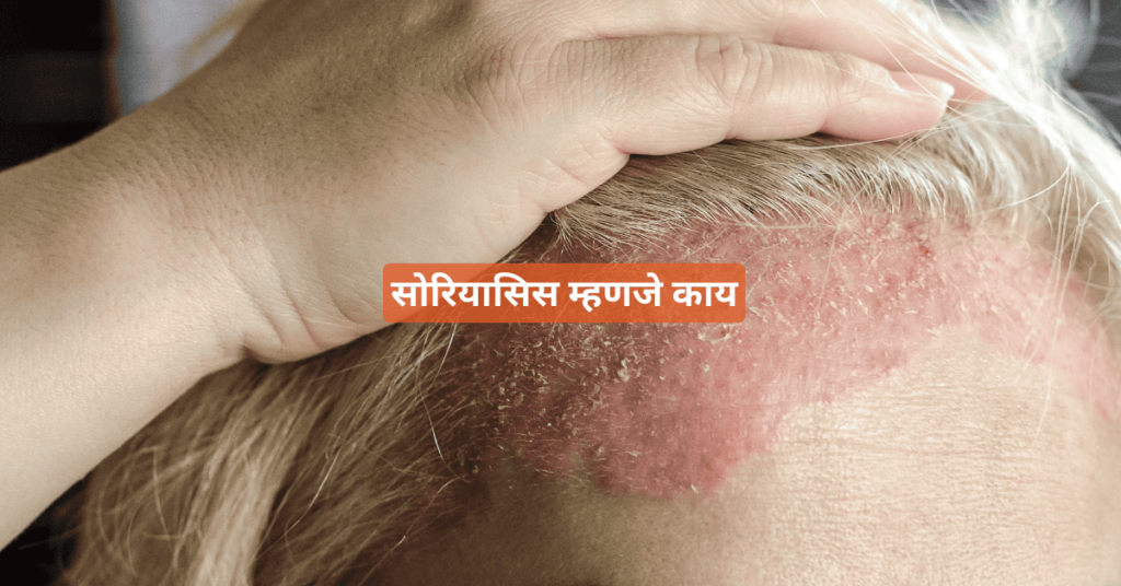 psoriasis mhanje kay psoriasis mhanje kay