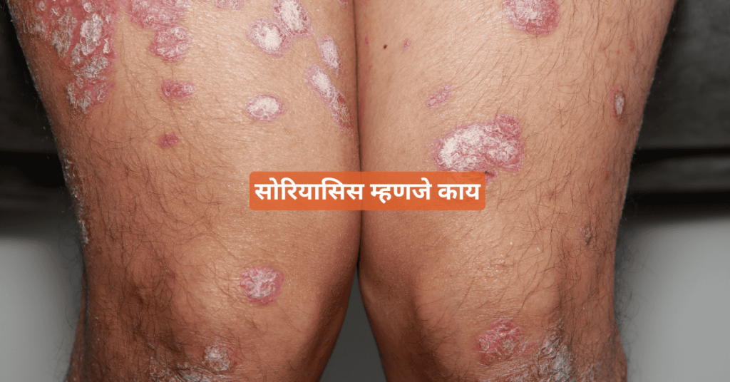 सोरियासिस म्हणजे काय मराठी अर्थ सोरियासिस म्हणजे काय मराठी अर्थ