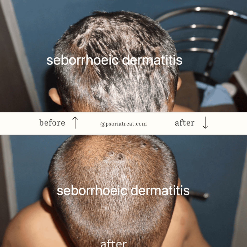 Seborrhoeic Dermatitis Homeopathic Treatment seborrhoeic dermatitis treatment at home