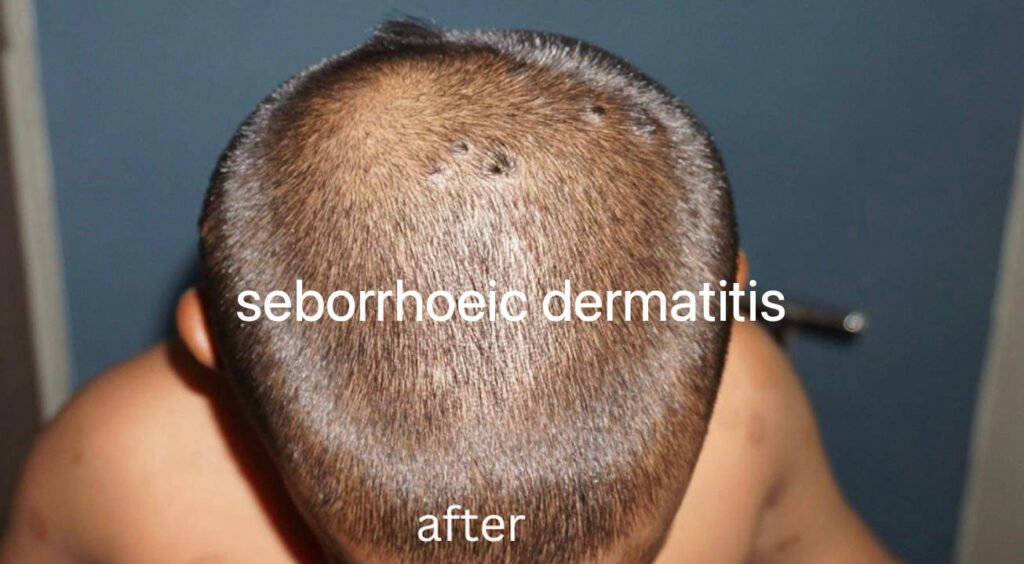 seborrhoeic dermatitis treatment at home seborrhoeic dermatitis treatment at home