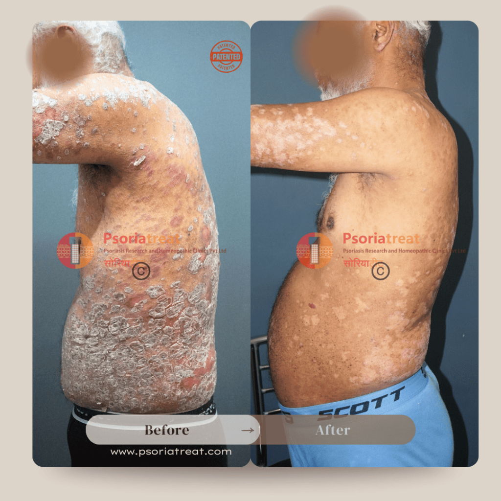 erythrodermic psoriasis treatment erythrodermic psoriasis treatment