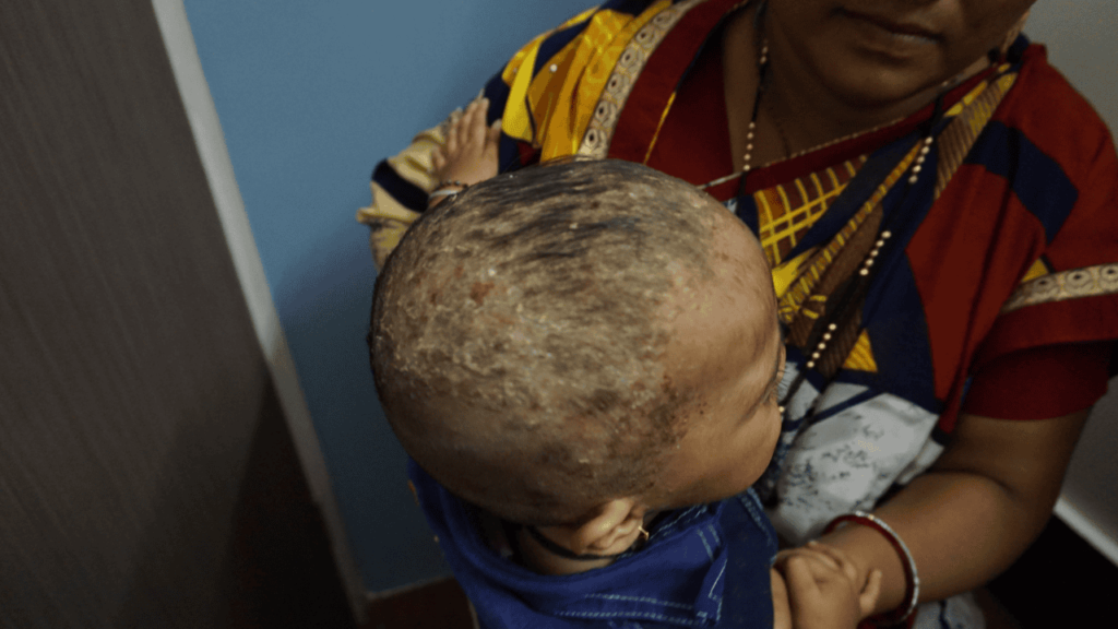 psoriasis in child psoriasis in child