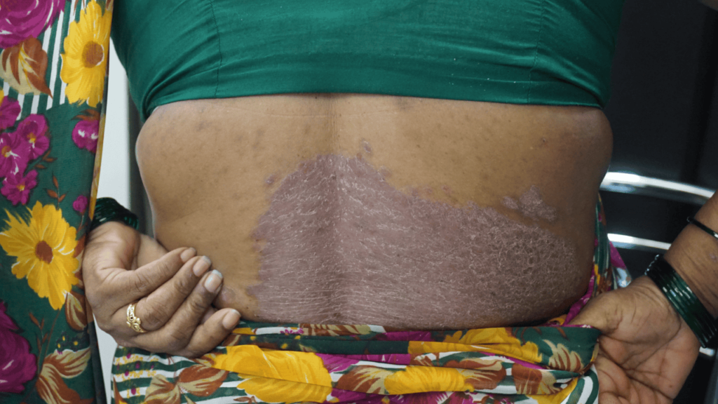 सोरायसिस मराठी माहिती सोरायसिस मराठी माहिती