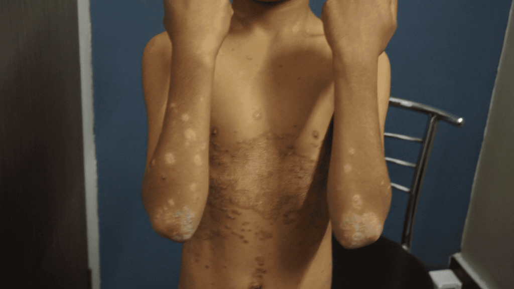 psoriasis marathi information psoriasis marathi information