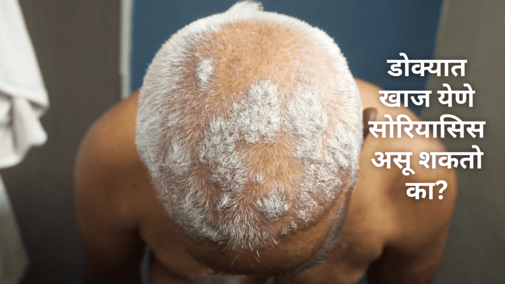 dokyat khaj yene upay in marathi डोक्यात खाज येणे सोरियासिस असू शकतो का
