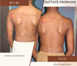 guttate psoriasis spread