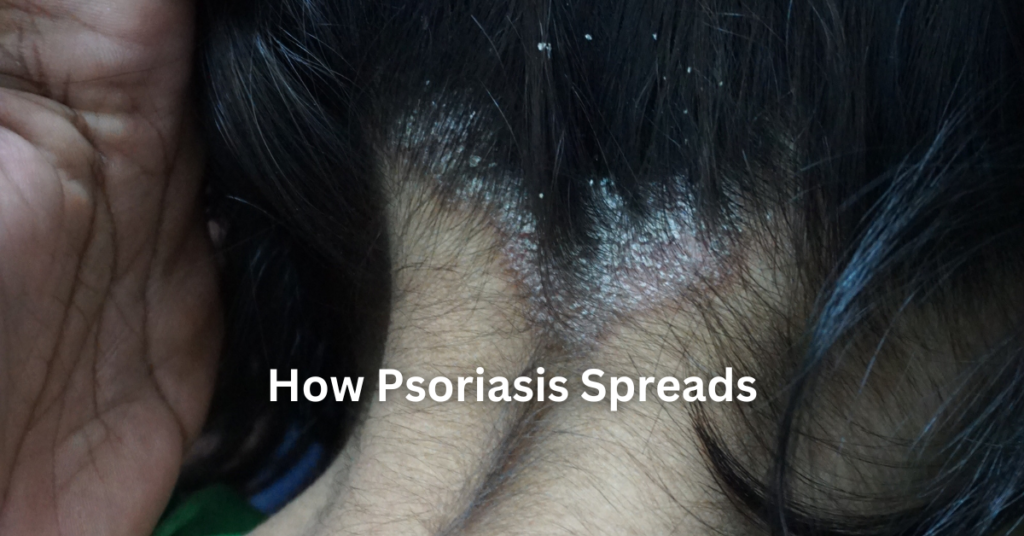 how psoriasis spreads