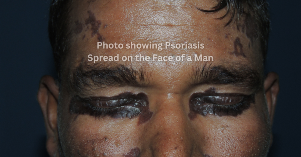 psoriasis spread