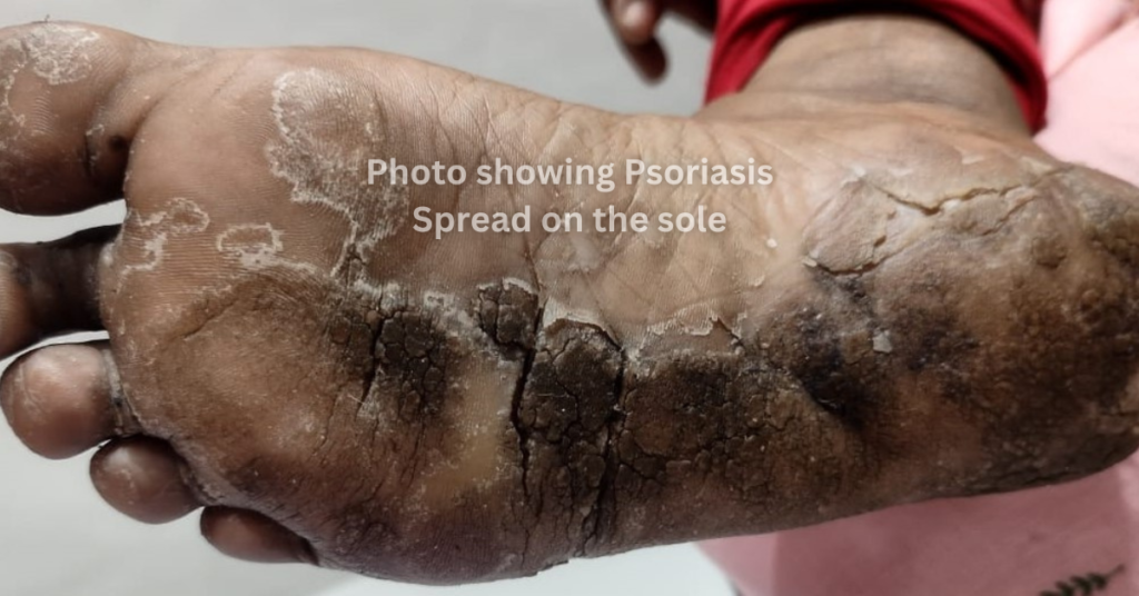 psoriasis spread on the sole