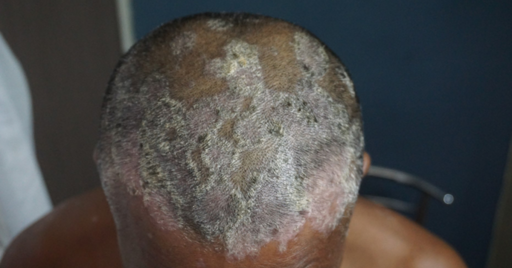 psoriasis spread on the scalp