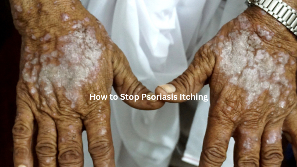 How to Stop Psoriasis Itching