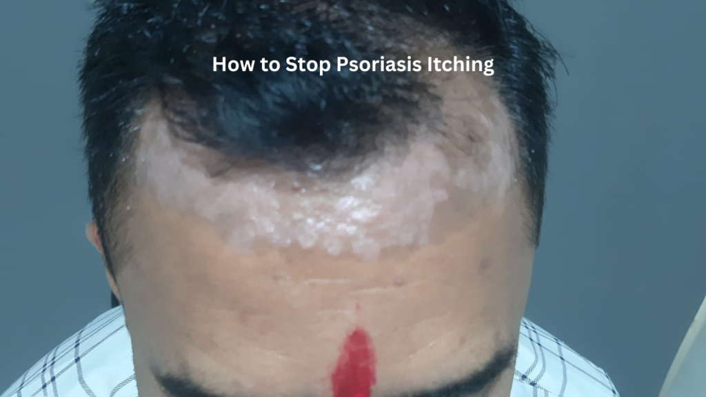 How to Stop Psoriasis Itching