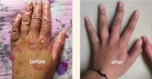 plaque psoriasis spread