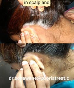 scalp psoriasis spread
