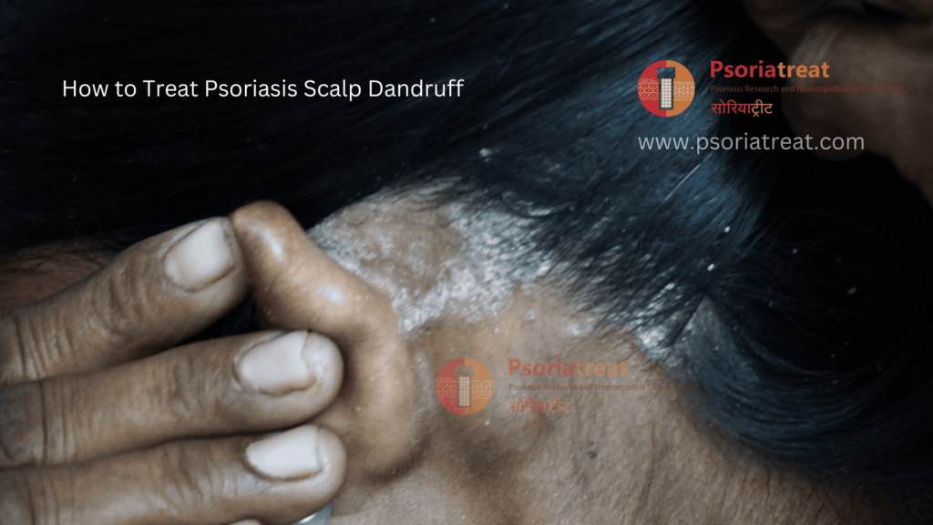how to treat psoriasis scalp dandruff how to treat psoriasis scalp dandruff