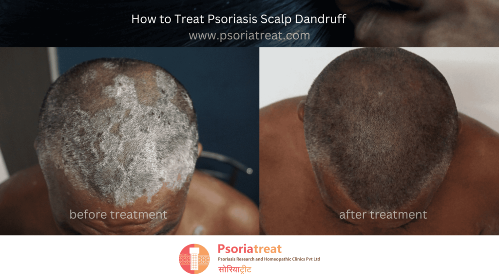 psoriasis scalp dandruff psoriasis scalp dandruff