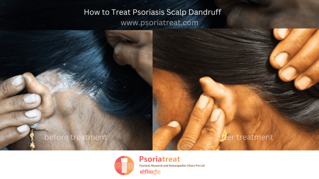 how to treat psoriasis scalp dandruff how to treat psoriasis scalp dandruff